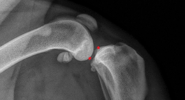 Knie met acuut gescheurde voorste kruisband zonder artrose